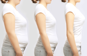 Woman Loses 140 Pounds, Ends Up Needing Surgery In Foreign Hospital